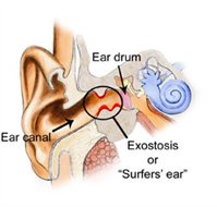 Surfers ear fysiology